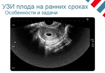 УЗИ на ранних сроках беременности