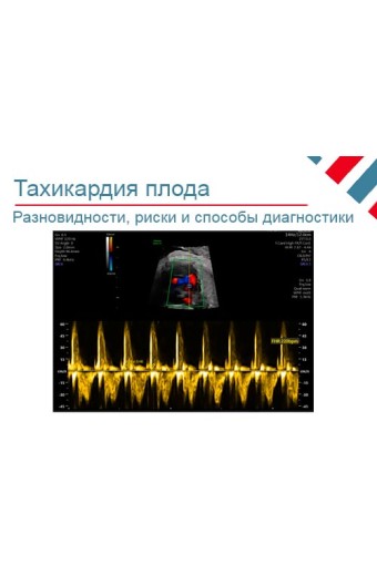 Тахикардия плода: виды, диагностика и лечение