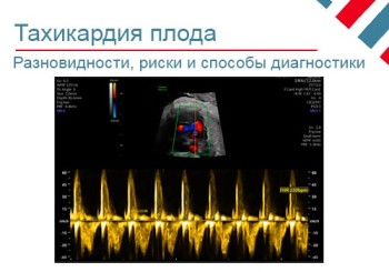Тахикардия плода: виды, диагностика и лечение