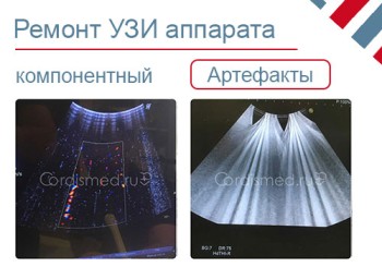 Устранение артефактов изображения УЗИ