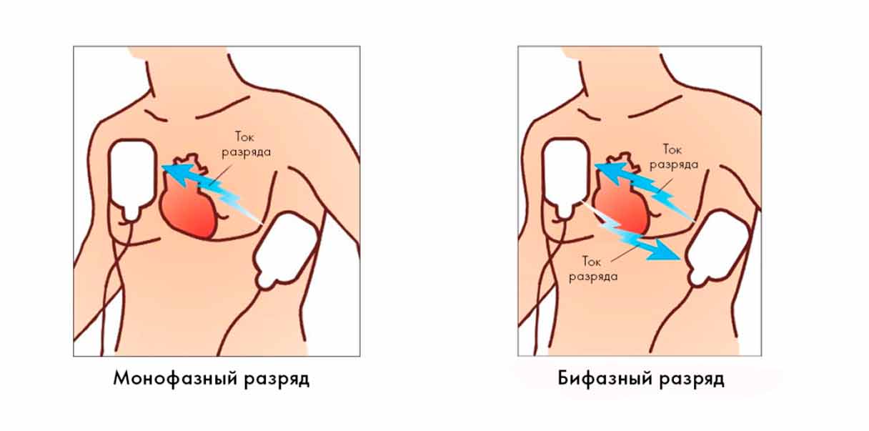 Схемы движения разряда при моно- и бифазной дефибрилляции