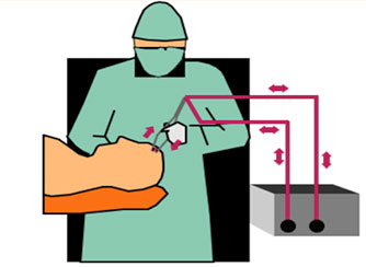 Биполярный режим работы эхвч аппарата (электрохирургического высокочастотоного аппарата, генератора)