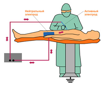 Монополярный режим работы эхвч аппарата (электрохирургического высокочастотоного аппарата, генератора)