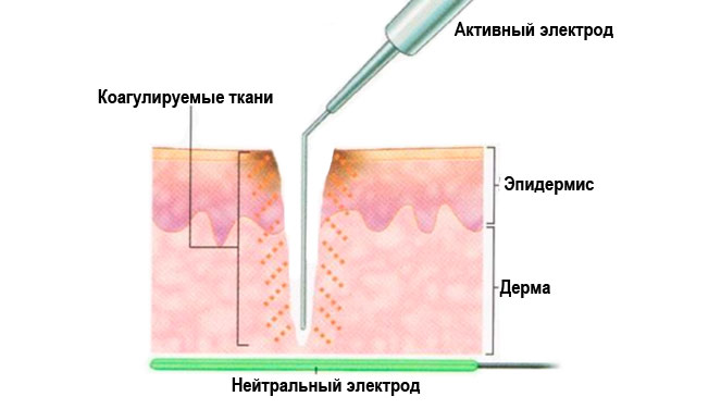 Рассечение тканей монополярным РВХ-аппаратом