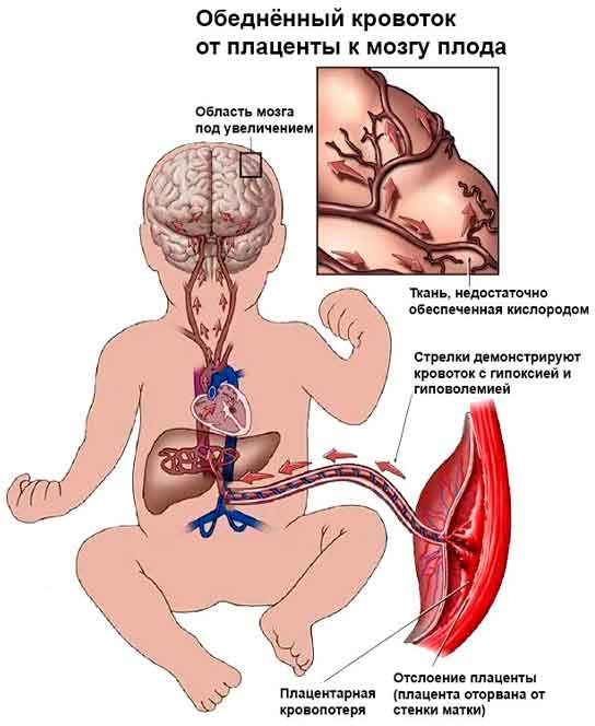 Ишемия головного мозга плода, вызванная гипоксией