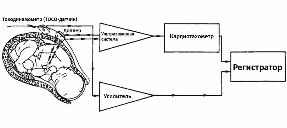 Кардиотокография