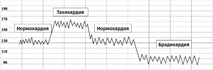 КТГ с разными видами сердечного ритма