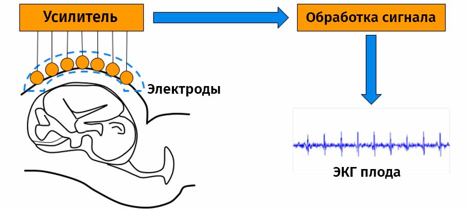 Непрямая ЭКГ плода