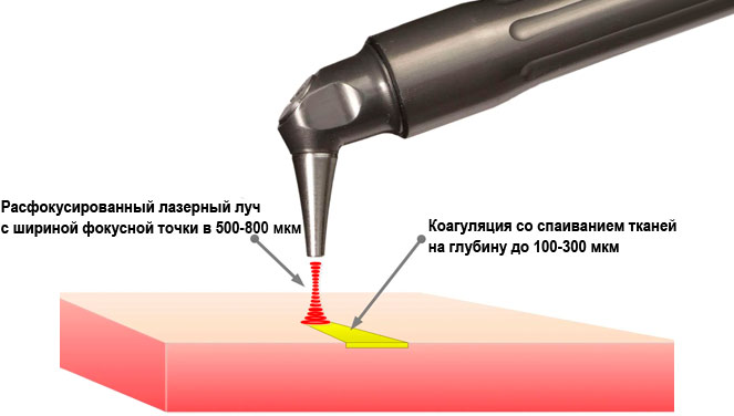 Коагуляция тканей хирургическим лазером