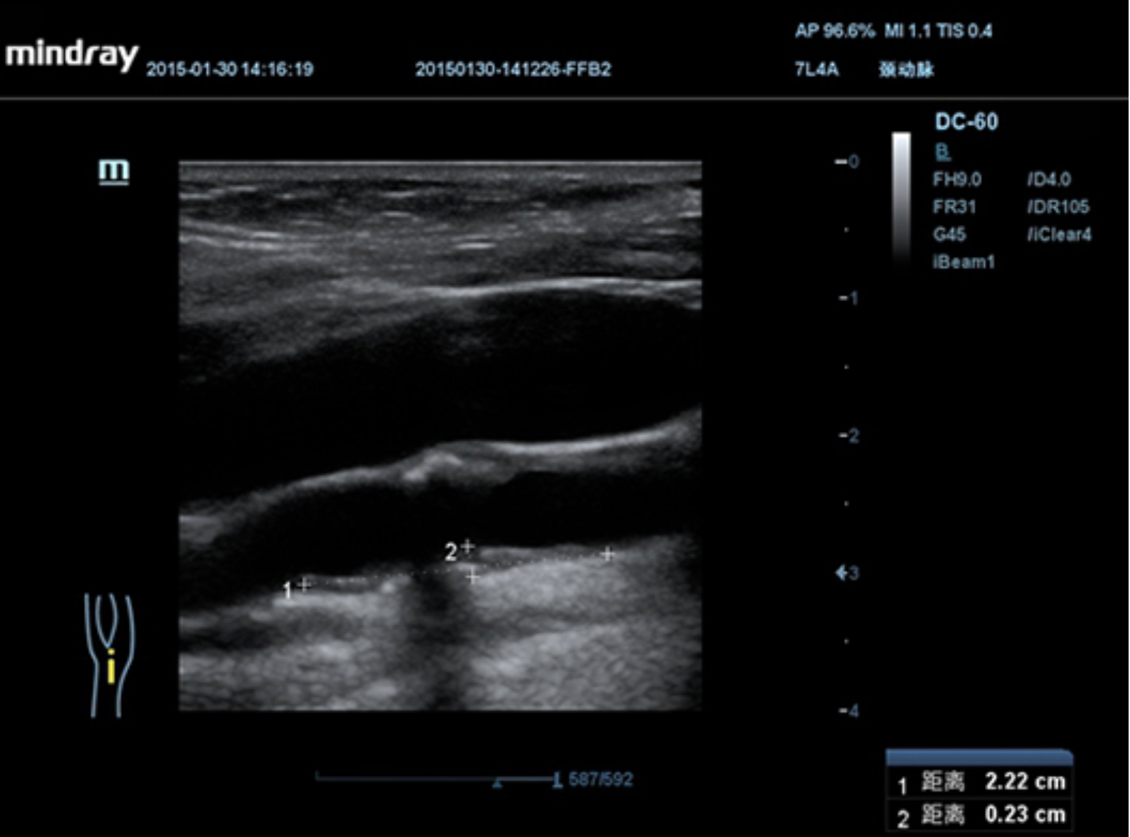 Визуализация атеросклеротической бляшки в сонной артерии в B-режиме на УЗИ аппарате Mindray DC-60
