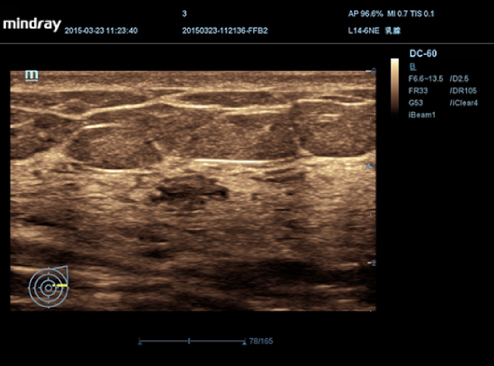 Визуализация опухоли в молочной железа на УЗИ аппарате Mindray DC-60