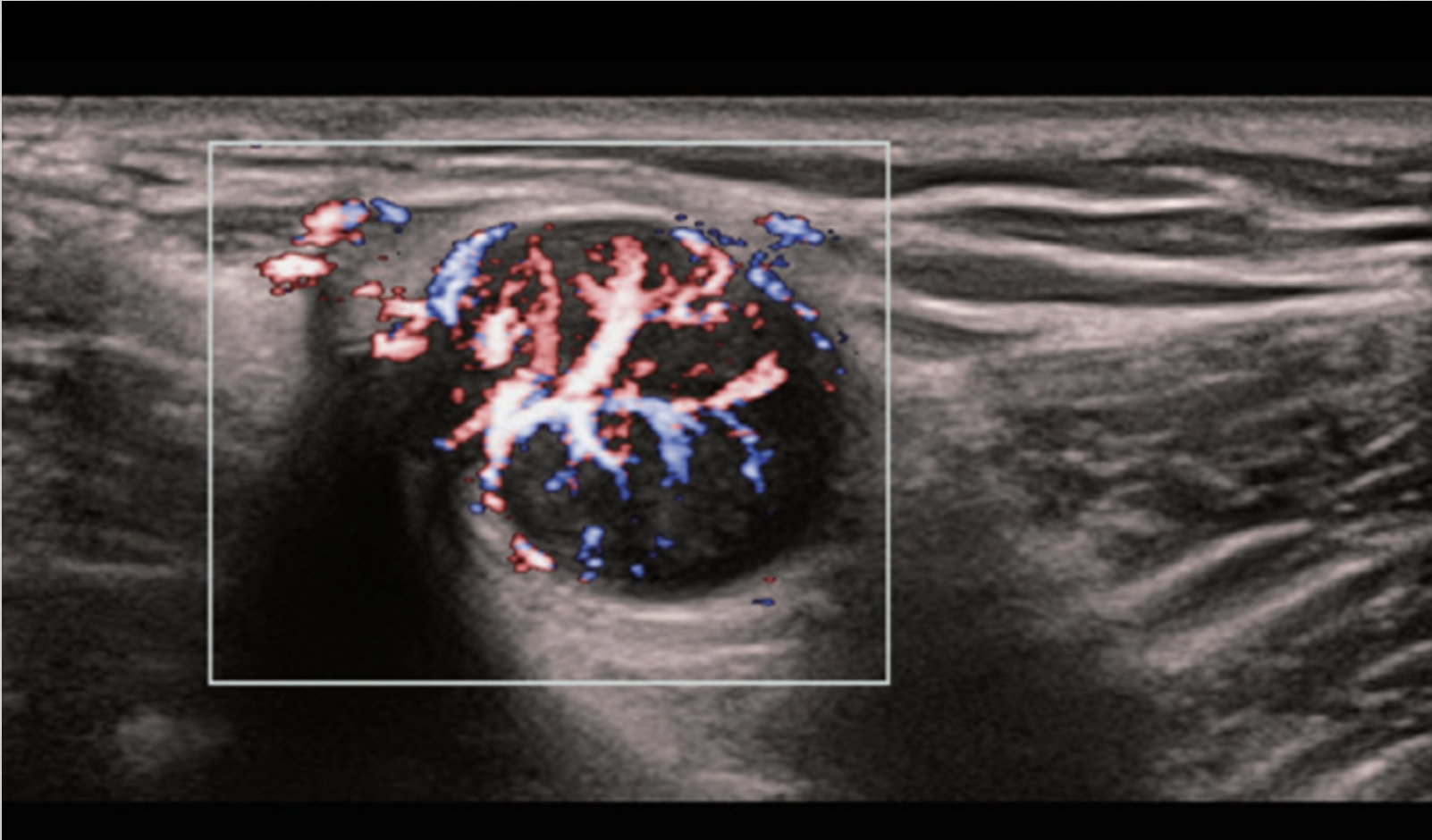 Визуализация метастатического лимфатического узла в режиме HR Flow на УЗИ аппарате Mindray Resona I9