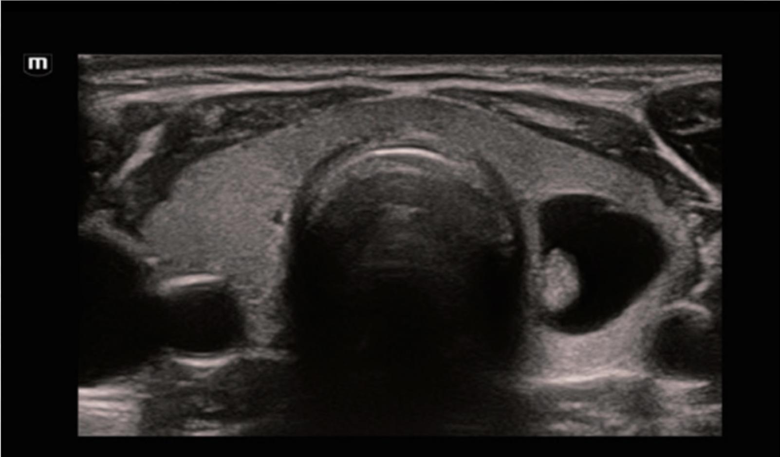 Визуализация узла в щитовидной железе на УЗИ аппарате Mindray Resona I9