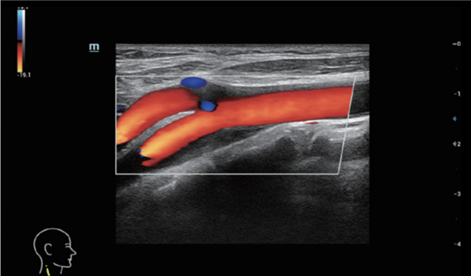 Визуализация стеноза сонной артерии на УЗИ аппарате Mindray Resona I9