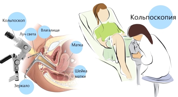 Как делается кольпоскопия